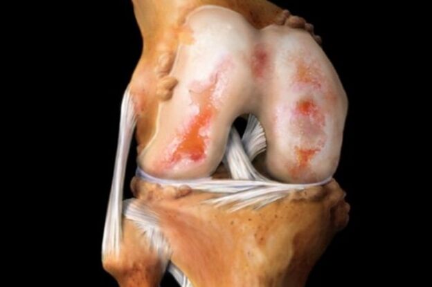 Distrugerea articulației genunchiului din cauza artrozei - o patologie comună a sistemului musculo-scheletic