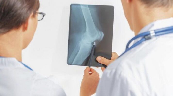 După diagnosticul necesar de artroză a articulației genunchiului, medicii prescriu un tratament complex