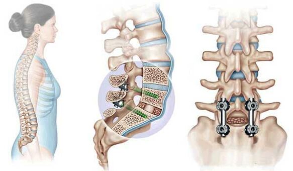 Fixarea vertebrelor deplasate cu implanturi într-un stadiu avansat de osteocondroză