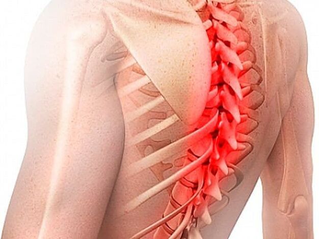 Osteocondroza coloanei vertebrale toracice este o formă rară a bolii
