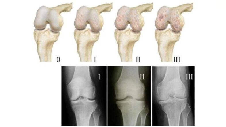Stadiile artrozei articulației genunchiului la radiografii