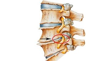 cauzele osteocondrozei cervicale