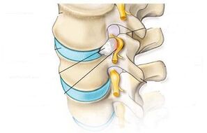 principalele simptome ale osteocondrozei cervicale
