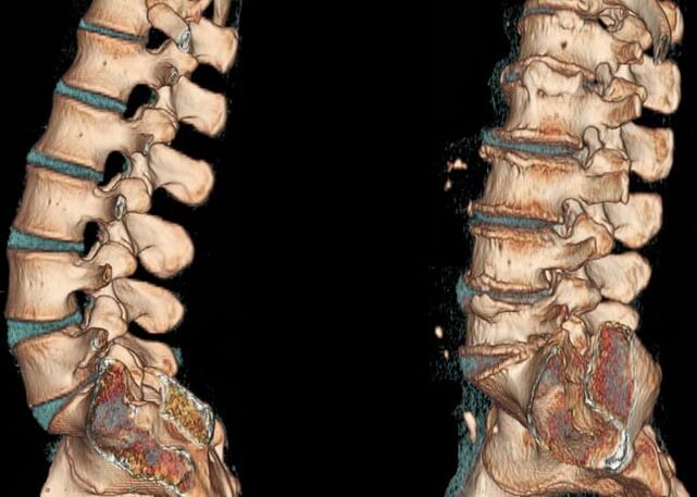 Scanarea CT a coloanei lombare în condiții normale și cu osteocondroză