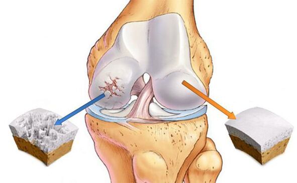Modificări articulare în artroză (stânga) și cartilaj normal (dreapta)