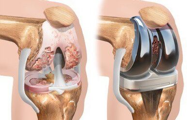 Endoprotetice ale articulației genunchiului cu gonartroză